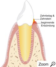 Geschädigter Zahnhalteapparat